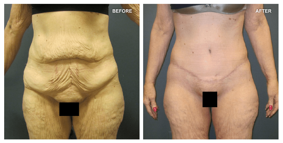 Abdominoplasty, female, age 37, 3 months after surgery by Jeffrey Gusenoff, MD